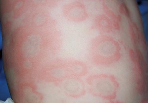 Bệnh mề đay dễ trị nếu xác định rõ nguyên nhân gây bệnh 