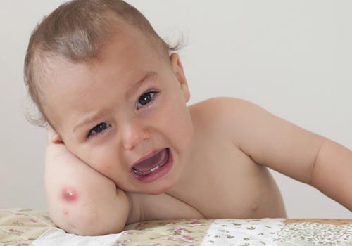 Mụn nhọt gây đau đớn, khó chịu cho trẻ