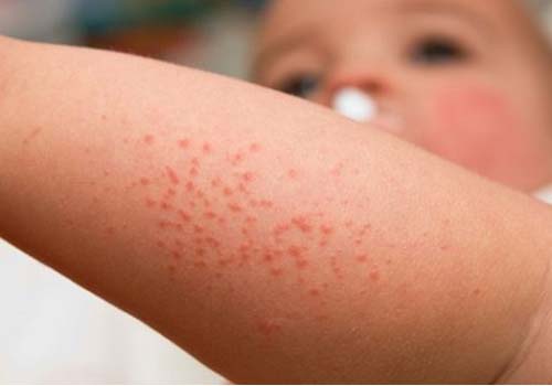 Hầu hết mọi trẻ em đều bị rôm sẩy