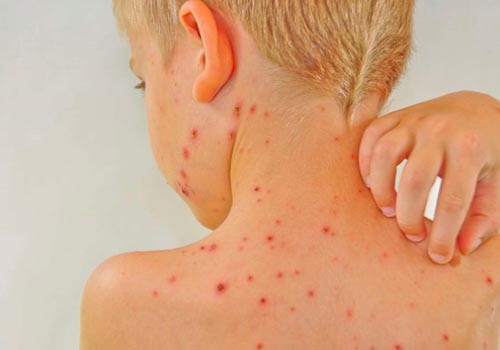 Mẩn ngứa gây khó chịu cho trẻ nhỏ