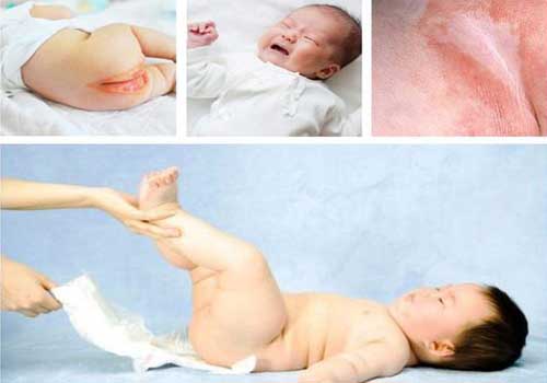 Tỷ lệ bé bị hăm tã ngày càng cao do cách dùng và sản phẩm bỉm tã quá nhiều trên thị trường mà chất lượng không đảm bảo