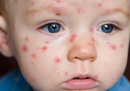 Mụn nhọt cũng phải kiêng sợ các bài thuốc dân gian
