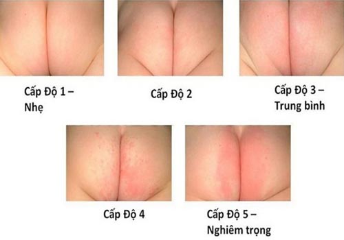 Các cấp độ của bệnh hăm tã