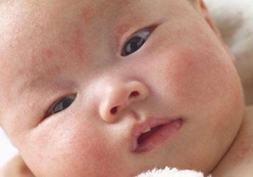 Cha mẹ cần bình tĩnh khi trẻ sơ sinh bị mụn đỏ trên mặt