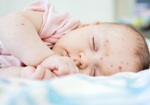 Rất nhiều trẻ bị nổi mụn khi mới được sinh ra