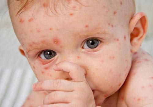 Ngoài việc gây ngứa, xuất hiện nhiều mụn nước bệnh thủy đậu còn có thể gây nhiễm trùng máu, viêm màng não nếu không điều trị kịp thời