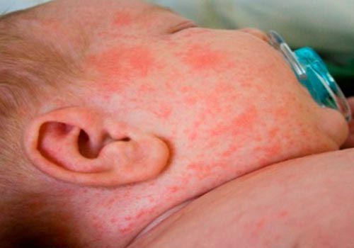Rôm sảy xuất hiện nhiều  vào mùa hè và nhiều thể khác nhau gây ngứa ngáy khó chịu cho bé