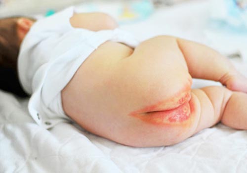 Rất nhiều trẻ sơ sinh bị hăm tã “ghé thăm” mùa nắng nóng nhất là với những bé sử dụng tã bỉm không đảm bảo
