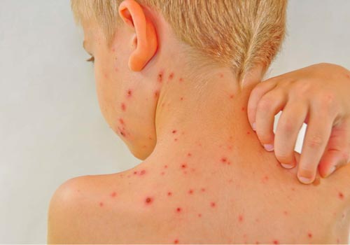 Làn da mỏng manh và non yếu là nguyên nhân khiến trẻ dễ bị dị ứng 