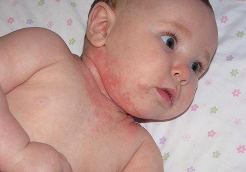 Các mẹ không nên xem thường triệu chứng mẩn ngứa ở trẻ em 