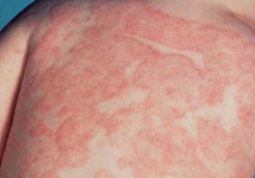 Nổi mề đay ở trẻ em là bệnh lý do dị ứng phổ biến hiện nay 