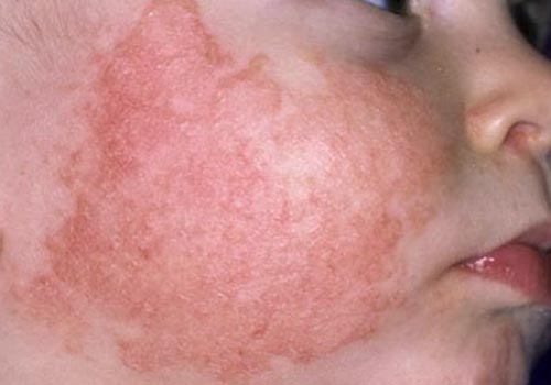 Viêm da cơ địa ở trẻ là chứng bệnh