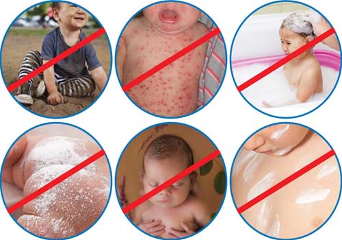 06 nguyên tắc vàng chăm sóc trẻ bị rôm sảy, mụn nhọt và các bệnh ngoài da