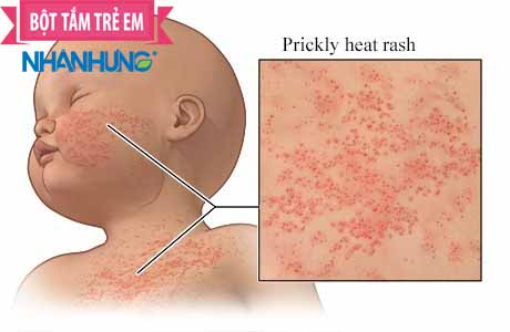 Những khu vực rôm sảy thường hoành hành
