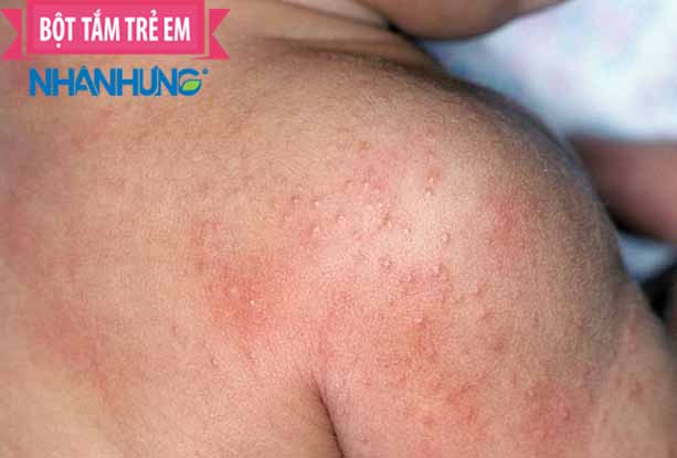Rôm sảy gây ngứa ngáy và khó chịu ở trẻ
