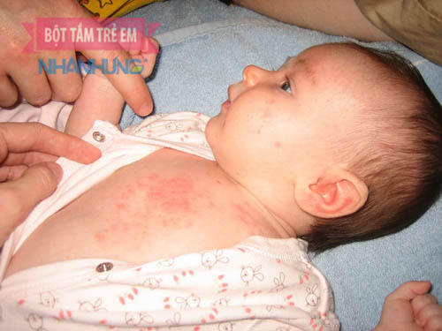 Bé bị rôm sảy mẹ cần Lau sạch mồ hôi, mặc quần áo mềm để hạn chế rôm sảy phát ban