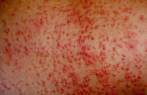 Rôm sảy nặng có thể gây nên những biến chứng nguy hiểm cho trẻ