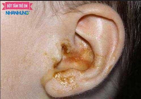 Bệnh viêm tai giữa ở trẻ em