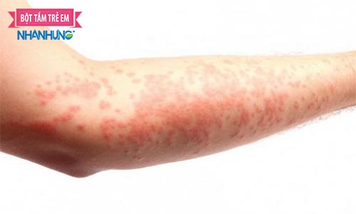 Một trong những nguyên nhân của bệnh Eczema là do di truyền