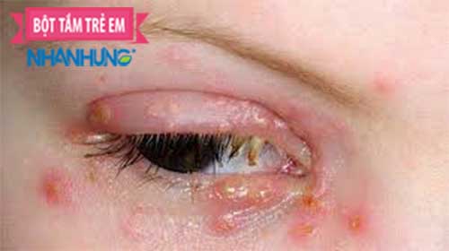 Hình ảnh giời leo ở mắt