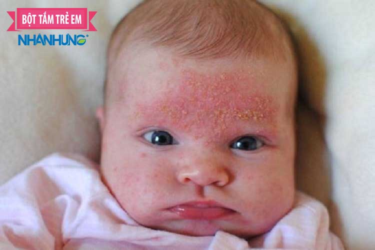 Chàm sữa rất khó chữa trị và dễ tái phát