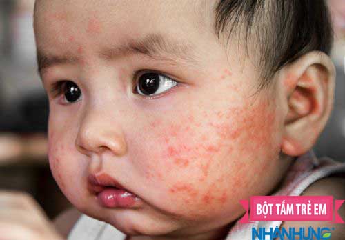 Chàm sữa ở trẻ khiến nhiều gia đình điêu đứng