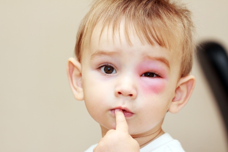 Khi vết thương có dấu hiệu bất thường cần cho bé đến các cơ sở y tế