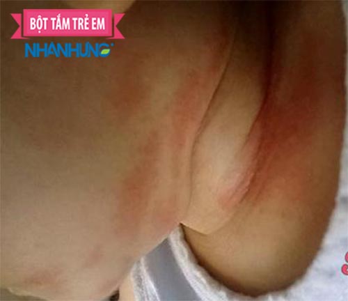Thời tiết nóng nực có thể gây ra tình trạng nổi mẩn ngứa ở cổ cho trẻ