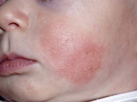 Viêm da cơ địa khiến bé Chíp khó chịu