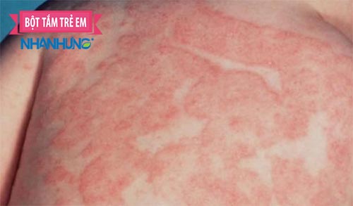 Ngứa toàn thân khiến người mắc vô cùng khó chịu