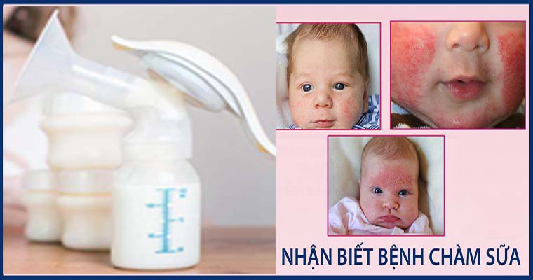 Thực hư về sữa mẹ chữa bệnh chàm?