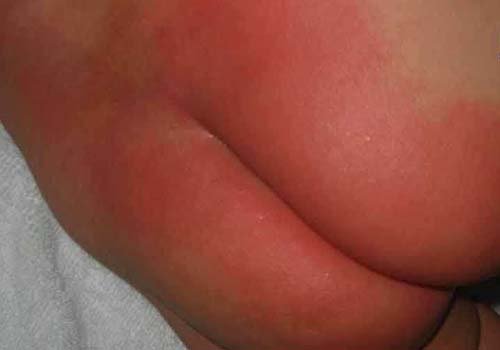 Mọi trẻ đều có thể bị hăm tã