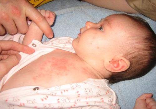 Bé bị rôm sảy nhiều ở vùng ngực, lưng do mồ hô tích tụ ứ đọng nhiều