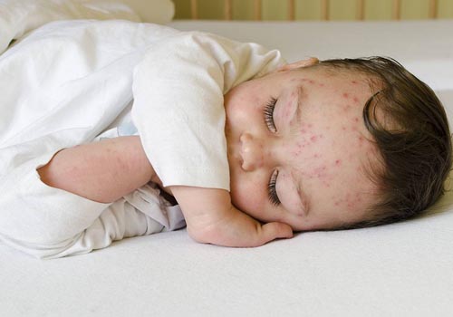Rôm sảy còn mọc nhiều trên đầu, trán và cổ khi bé tiếp xúc với môi trường nắng nóng và ô nhiễn