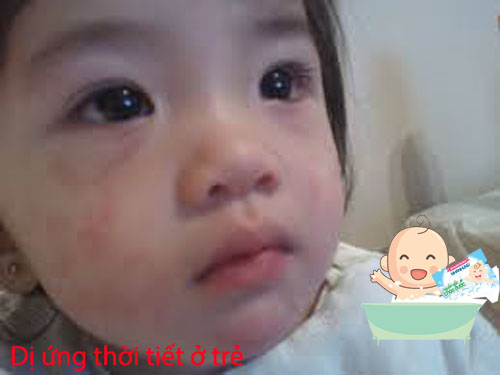 trẻ em bị dị ứng thời tiết