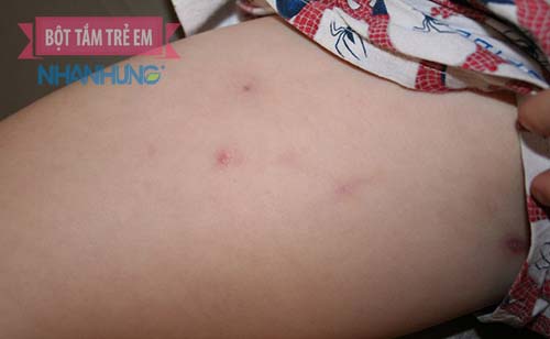 Mụn nhọt ở trẻ không chỉ có một loại mà còn có mụn bọc, mụn đầu đen, mụn đinh râu…