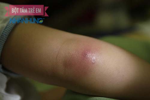 Mụn nhọt xuất hiện ở nhiều vị trí trên cơ thể trẻ