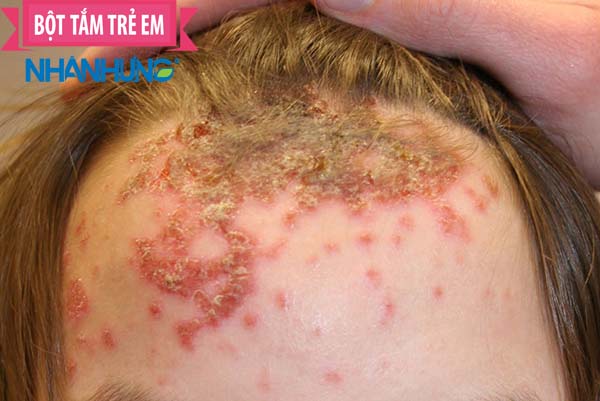 Cứ 10 bé lại có 1 bé mắc phải bệnh lý chốc đầu