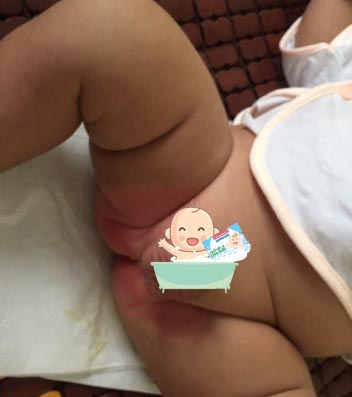 Bỉm tã không chất lượng và không thay thường xuyên khiến trẻ sơ sinh bị hăm tã tái phát nhiều lần