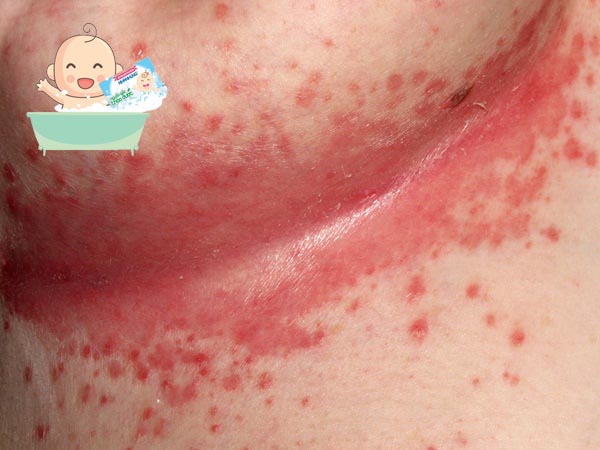 Vệ sinh và sử dụng sản phẩm trị hăm không đúng cách