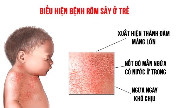 Rôm sảy khiến trẻ vô cùng ngứa ngáy, khó chịu