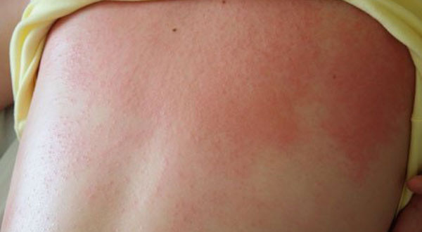 Rất nhiều trẻ khốn khổ chỉ vì rôm sảy
