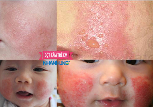 Vùng da 2 má xuất hiện những mảng ban hồng, có mụn nước liti sau vỡ ra và đóng mài, tróc vảy kèm theo ngứa