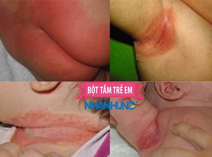 Bé bị mẩn đỏ kèm theo tổn thương(tợt da, nổi mụn) tại các vùng bẹn, háng, cổ, cánh tay hoặc vùng da có nếp gấp