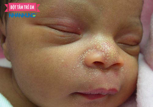 Mặt bé nổi mụn trắng sữa li ti kèm theo ngứa ngáy (bé thường quơ tay lên mặt hoặc gãi liên tục) > Chi tiết về bệnh chàm sữa và cách