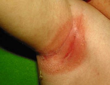 Da bé tấy đỏ, lở loét khi bị hăm da vùng nách
