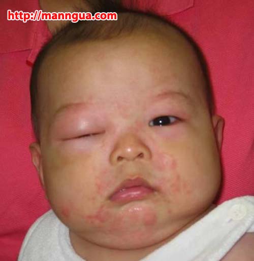Mụn đỏ trên mặt