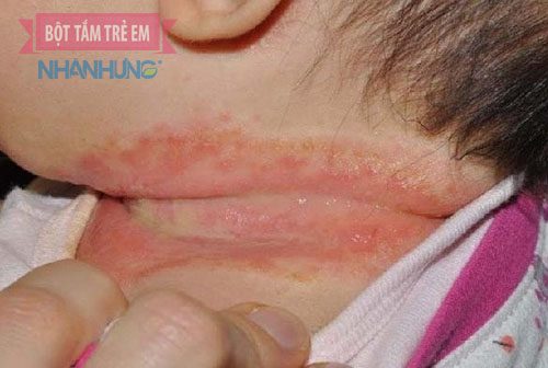 Hăm cổ khiến bé đau đớn, khó chịu
