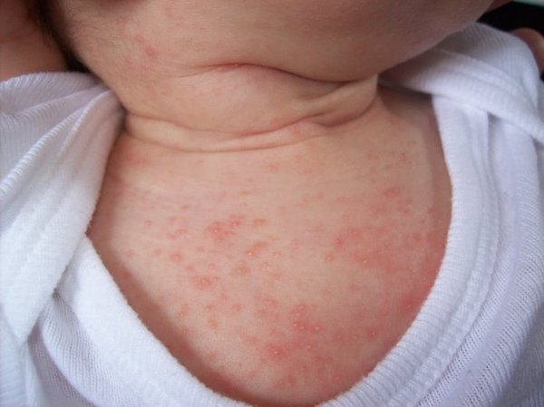 Các vết rôm có thể bội nhiễm tạo ra mụn mủ, gây ngứa và đau đớn cho trẻ