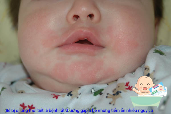 Bé rất dễ bị dị ứng khi thời tiết giao mùa